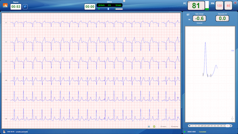 CardioSW - Stress Test, Interpretation Software - Medical equipment / Equipo medico - Mediventa USA